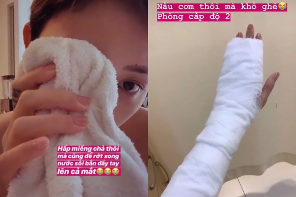 Lâu lâu mới lại xắn tay vào bếp trổ tài nữ công gia chánh, Tóc Tiên bị bỏng cấp độ 2 phải đi bệnh viện băng bó