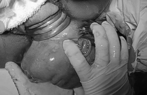 Bé gái sinh thường với dây rốn quấn cổ 4 vòng như đeo kiềng