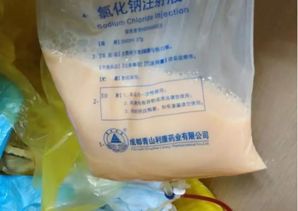 Túi mỡ 300ml lấy ra từ máu người đàn ông 47 tuổi chỉ vì hay ăn thực phẩm này Túi mỡ 300ml lấy ra từ máu người đàn ông 47 tuổi chỉ vì hay ăn thực phẩm này