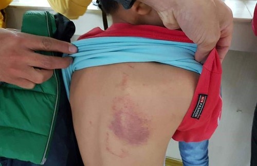 Cô giáo đánh học sinh tím lưng ở Hải Phòng bị phạt 5 triệu đồng