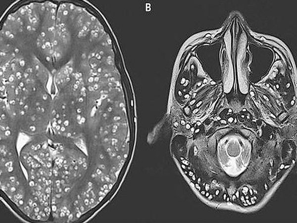Nam thanh niên chết vì sán xơ mít, loại sán này nguy hiểm tới mức nào?