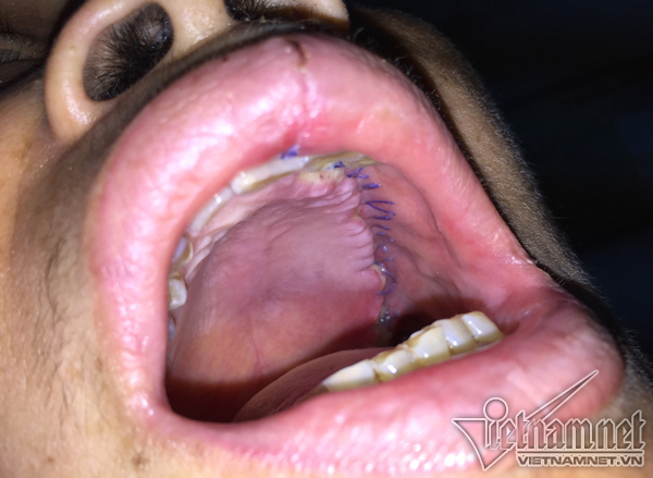 Nghiện món triệu quý ông mê, người đàn ông Hà Nội phải nạo nửa mặt vì ung thư