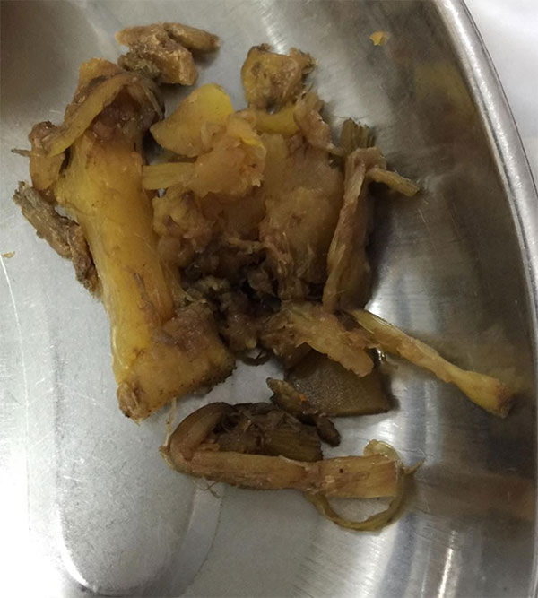 Một lạng măng khô kẹt trong bụng người đàn ông