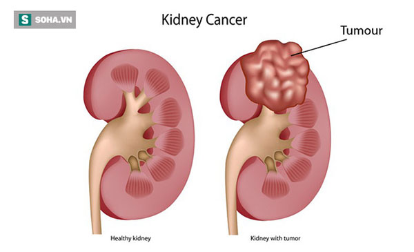 4 yếu tố chủ yếu có thể dẫn đến ung thư thận: Bất kỳ lứa tuổi nào cũng nên biết để tránh