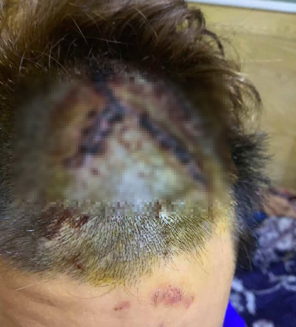 Giang hồ đánh 2 người thương tích nặng, tiếp tục vào viện truy sát