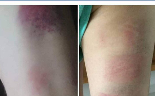 Cuộc điện thoại khiến phụ huynh bức xúc của cô chủ nhiệm bị tố đánh 22 học sinh