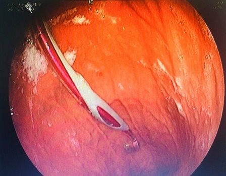 Hóc xương cá dùng bàn chải đánh răng giải cứu rồi nuốt cả vào bụng