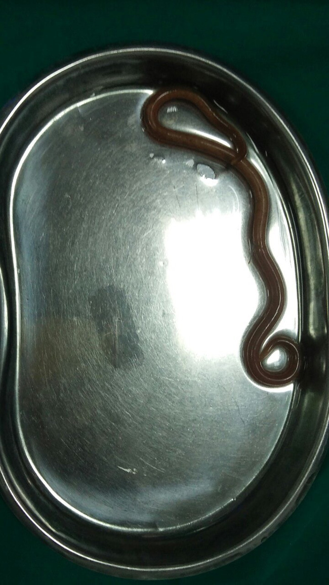 Đau bụng quanh rốn, hoa mắt chóng mặt không ngờ bị kí sinh trùng giun đũa dài 15cm sống trong dạ dày