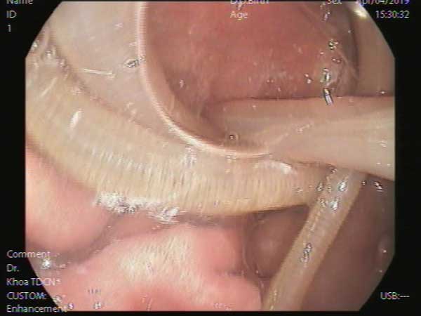 Đau bụng quanh rốn, hoa mắt chóng mặt không ngờ bị kí sinh trùng giun đũa dài 15cm sống trong dạ dày