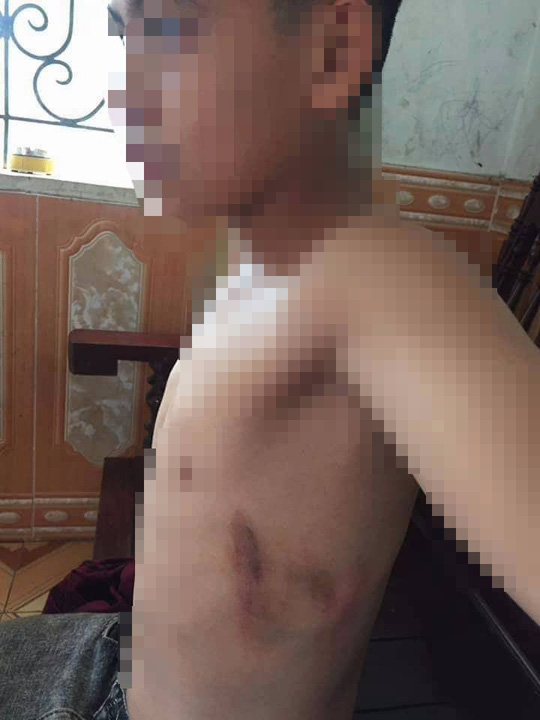 Phụ huynh xông vào trường học đánh học sinh lớp 7 thâm tím người