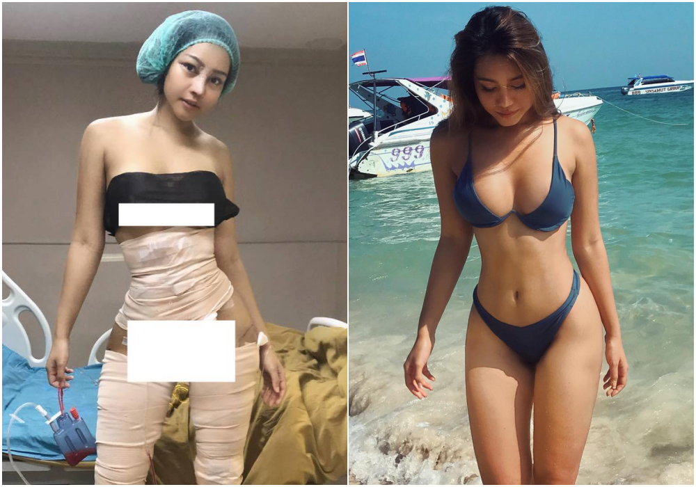 Hot girl bốc lửa Thái Lan bất ngờ công khai ảnh phẫu thuật để có eo con kiến, điều đáng nói đây không phải lần đầu cô lột xác