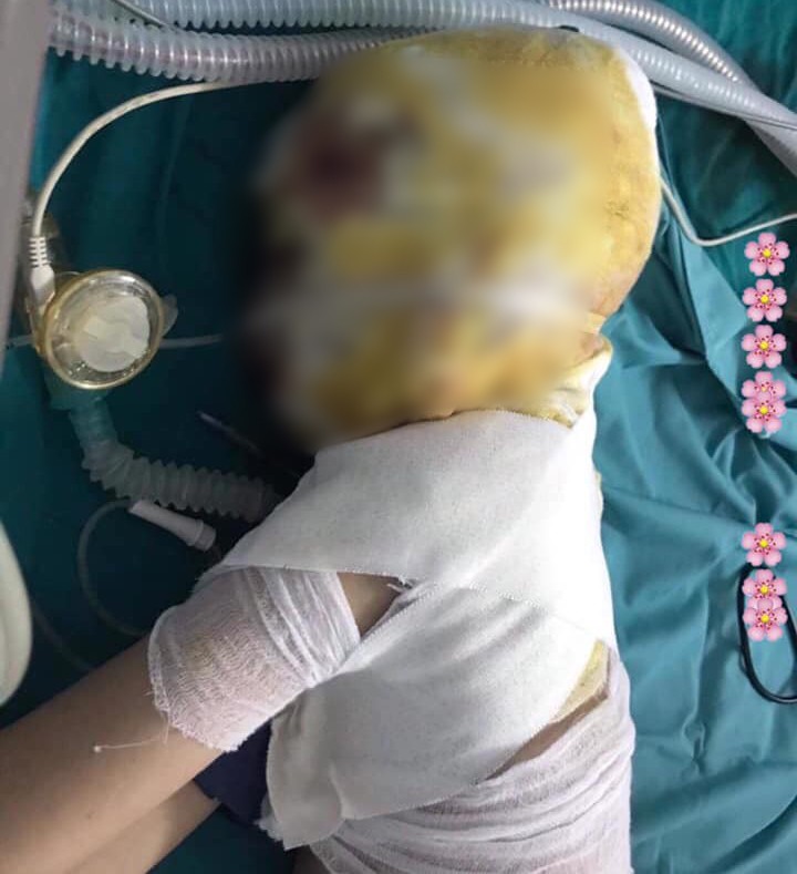 Xót xa cảnh bé trai dân tộc 9 tuổi bị ngã vào bếp củi, bỏng nặng toàn bộ khuôn mặt: Lúc ấy tôi không khóc nổi, nhìn con mà đau...