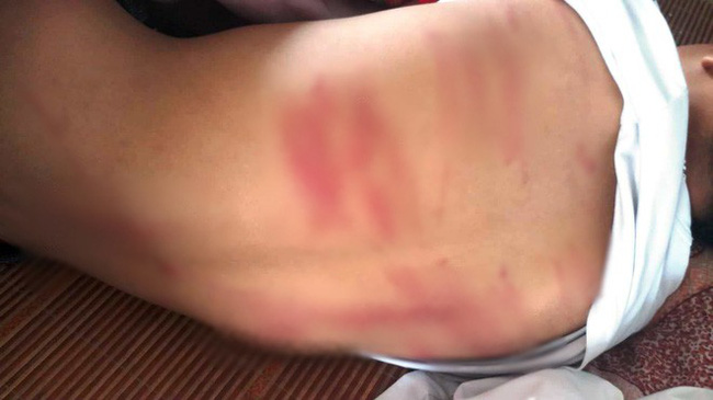 Hà Tĩnh: Nghi bị bố ruột đánh bầm tím người, nam sinh lớp 8 đến trường hoảng sợ rồi ngất xỉu