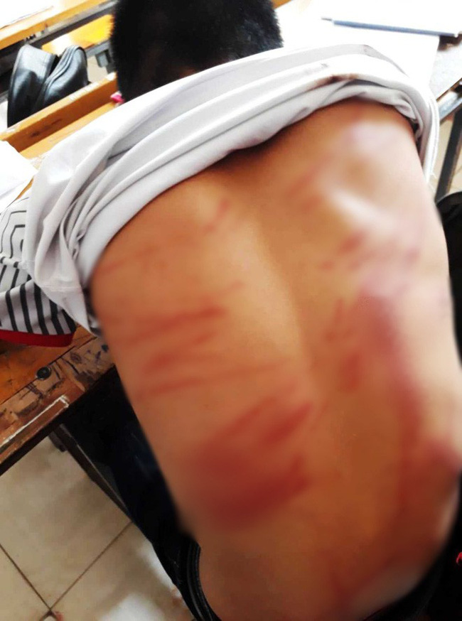 Hà Tĩnh: Nghi bị bố ruột đánh bầm tím người, nam sinh lớp 8 đến trường hoảng sợ rồi ngất xỉu