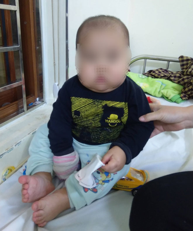 Bé trai 17 tháng tuổi bị suy thượng thận do uống thuốc ho chứa corticoid