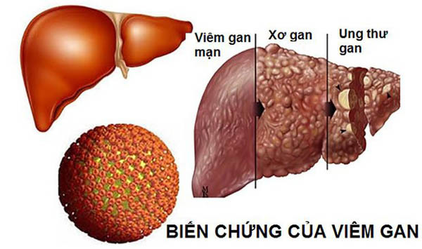 Giám đốc 40 tuổi bị ung thư gan vì làm 4 việc trong thời gian dài