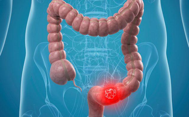 Người phụ nữ 2 lần tái phát ung thư trong 4 năm, 2 thói quen này đã làm hại cô