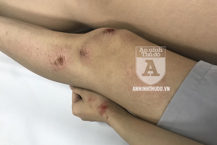 Xuất hiện kẻ bệnh hoạn chuyên xâm hại các cô gái trên đường phố Hà Nội