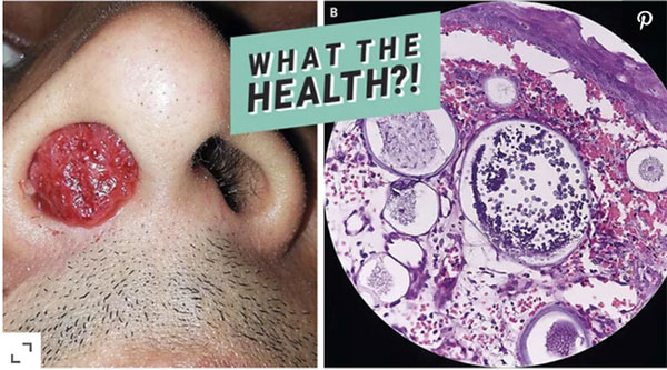 Chàng trai 27 tuổi bị chảy máu mũi sau khi tắm ao, cảnh báo bệnh nguy hiểm tấn công khi tắm ao hồ