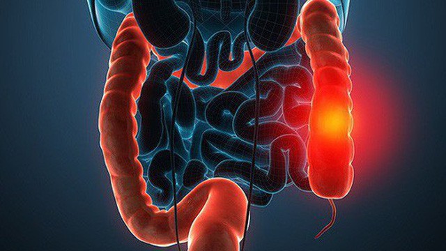 Chủ quan với chứng táo bón khiến cô gái này qua đời khi mới 33 tuổi