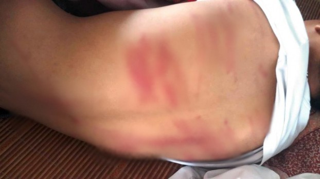 Bố đánh con trai lớp 8 nhập viện: Cháu bé có 79 vết thương, vẫn hoảng loạn tinh thần