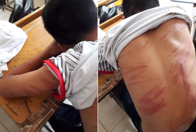 Người bố đánh con trai 79 vết thương có thể bị xử lý hình sự