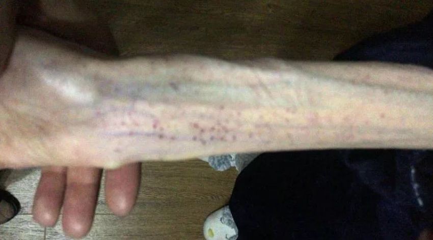 Cô gái 21 tuổi chỉ còn da bọc xương sau khi cố sức giảm cân liên tục suốt 3 năm