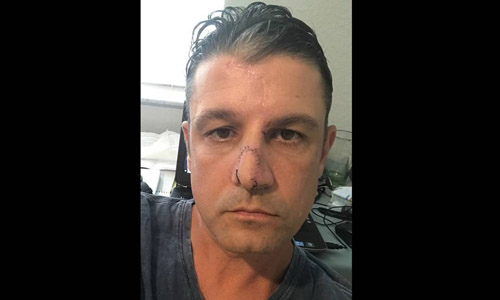 Phóng viên Mỹ kể về giây phút kinh hoàng bị chó cắn nát mặt