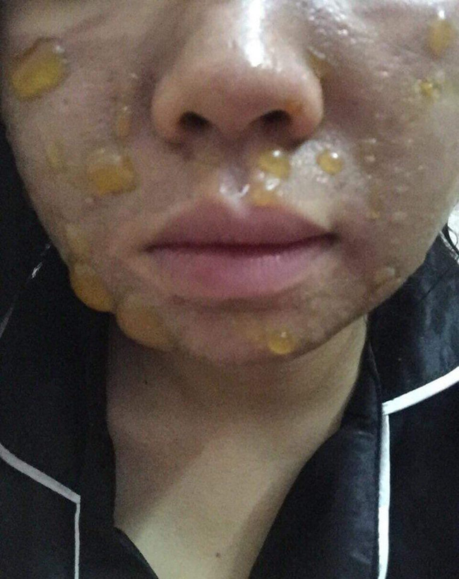 Kinh hãi hình ảnh cô gái bị nổi bóng nước khắp mặt vì làm đẹp: Chuyên gia cảnh báo điều quan trọng trước khi peel da