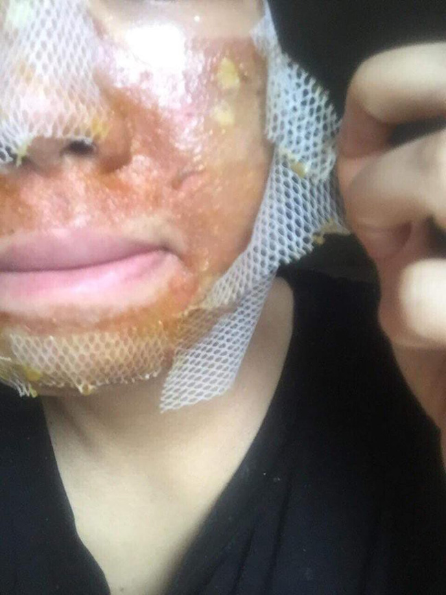 Kinh hãi hình ảnh cô gái bị nổi bóng nước khắp mặt vì làm đẹp: Chuyên gia cảnh báo điều quan trọng trước khi peel da