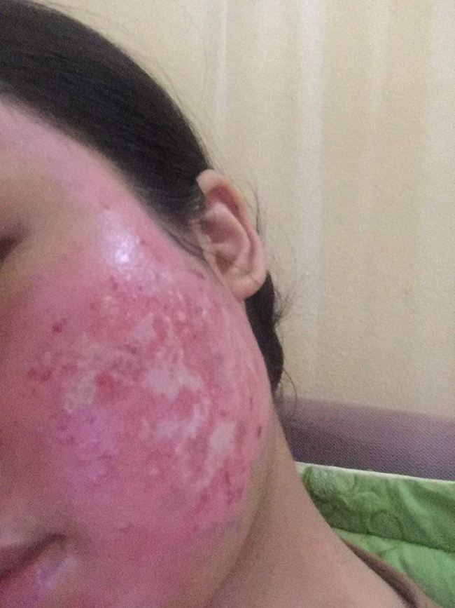 Kinh hãi hình ảnh cô gái bị nổi bóng nước khắp mặt vì làm đẹp: Chuyên gia cảnh báo điều quan trọng trước khi peel da