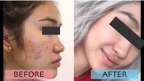 Kinh hãi hình ảnh cô gái bị nổi bóng nước khắp mặt vì làm đẹp: Chuyên gia cảnh báo điều quan trọng trước khi peel da