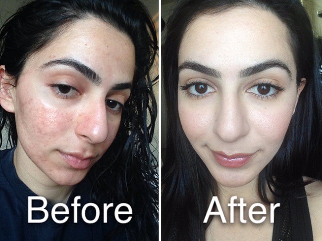 Kinh hãi hình ảnh cô gái bị nổi bóng nước khắp mặt vì làm đẹp: Chuyên gia cảnh báo điều quan trọng trước khi peel da