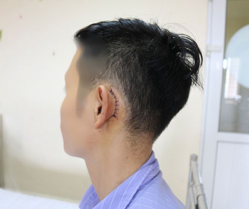 Sạc điện thoại bên gối, nam thanh niên thủng màng nhĩ