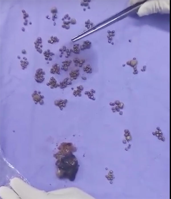 Phát hoảng vì thận bệnh nhân đầy cứng sỏi, BS tư vấn cách vỗ lưng tự đẩy sỏi ra ngoài