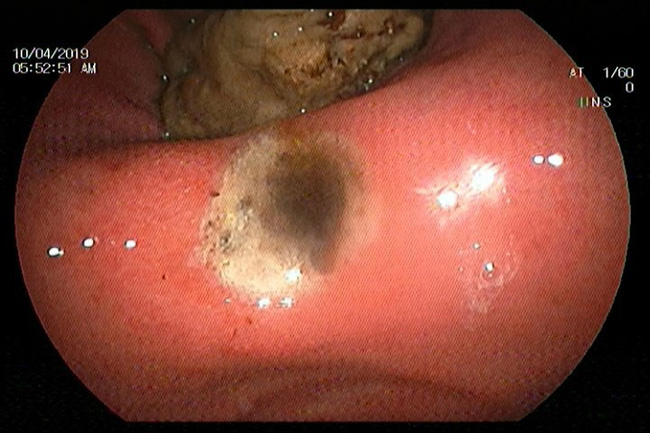 Dùng bột nghệ sai cách, nhiều người rước bệnh vào thân