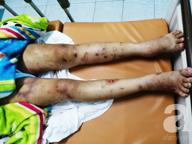 Cô gái mang bầu 6 tháng bị bắt cóc, tra tấn đến sảy thai bị sang chấn tâm lý, la hét, kích động trong bệnh viện