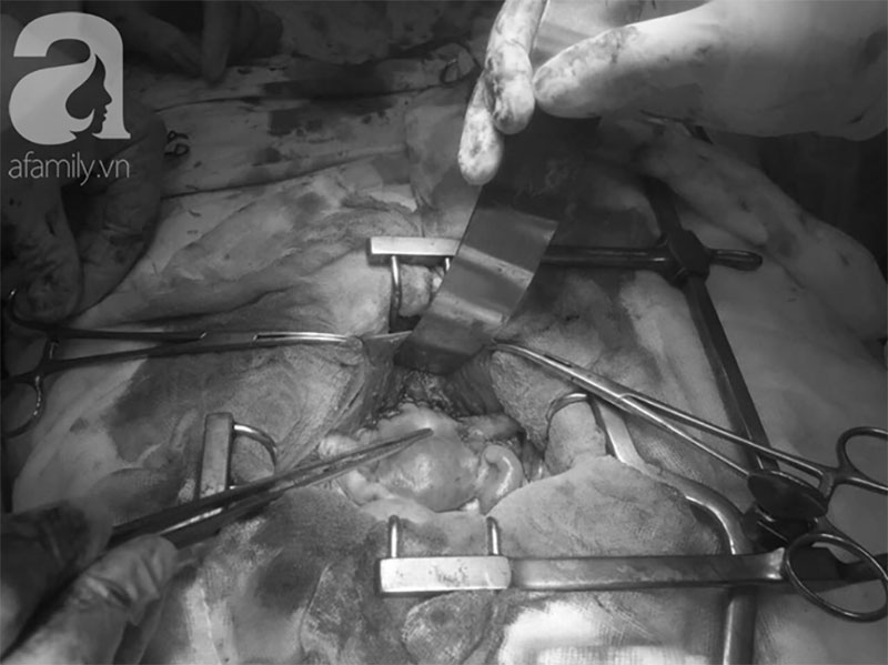 Vừa có kỳ kinh nguyệt đầu tiên, bé gái 14 tuổi ở Bình Dương đã phát hiện ung thư tử cung thời kỳ cuối