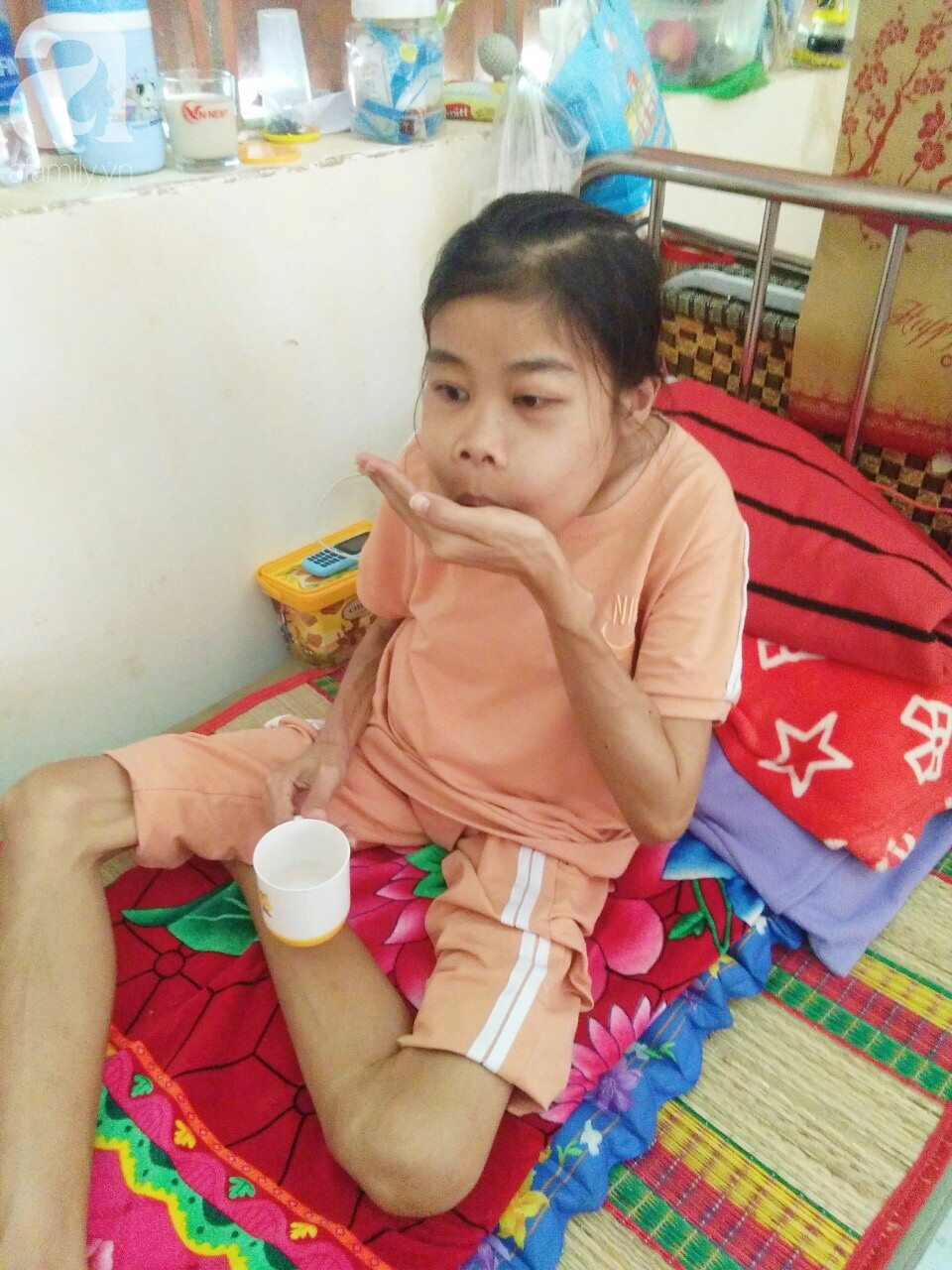 Bị suy thận nhưng vẫn cố giữ thai nhi, người mẹ bị biến dạng khuôn mặt, chấp nhận chết để con gái nhỏ được chào đời