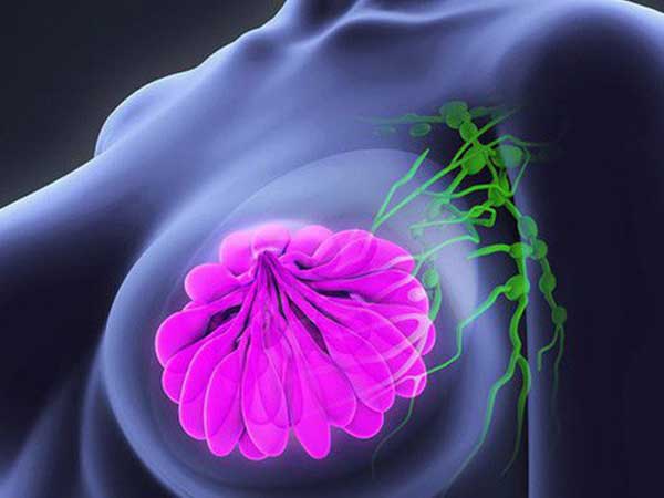 Ung thư hay gặp nhất ở nữ giới: Bác sĩ chỉ cách nhìn - sờ - quan sát để tự phát hiện sớm