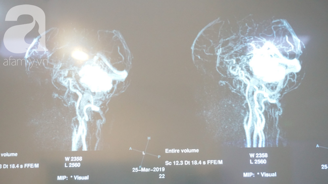 15 giờ phẫu thuật ngoạn mục cứu nữ bệnh nhân mang khối u não khổng lồ, nhiều bệnh viện đã chê