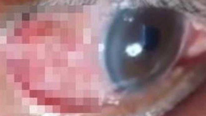 Người đàn ông suýt mù vì giun chỉ dài 15 cm ký sinh trong mắt