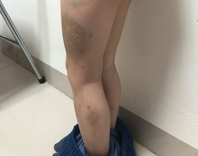 Hà Nội: Mẹ ruột tố con trai lớp 1 bị mẹ kế bạo hành bằng dép và gậy khiến bé bầm tím cả người