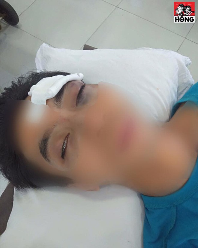 Trời nóng càm ràm nhiều, chồng bị vợ ném điện thoại vào mặt, chấn thương phải đi cấp cứu gấp