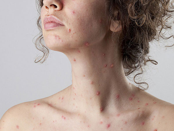 Nữ tiếp viên hàng không rơi vào tình trạng hôn mê 10 ngày do biến chứng đáng sợ của bệnh sởi