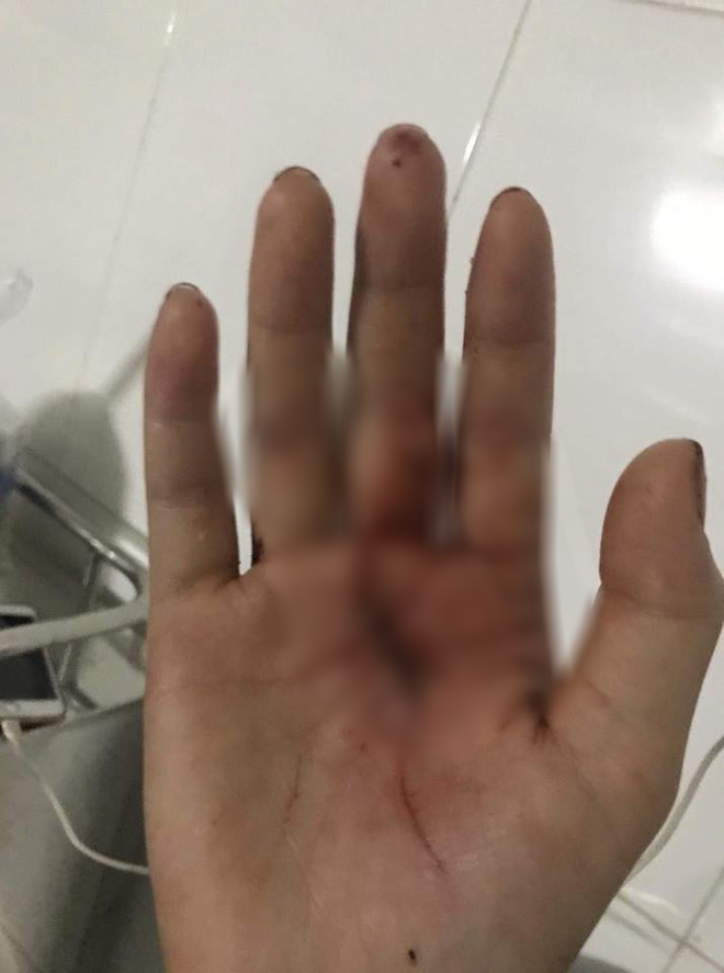 Chị ruột cô gái bị tấn công phải khâu 60 mũi: Mặt em tôi bị rạch như thế thì coi như hết đời người rồi