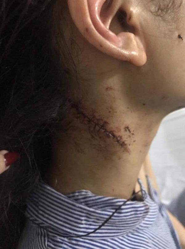 Chị gái thiếu nữ xinh đẹp bị rạch mặt: Em tôi kêu có thai mà họ vẫn không tha