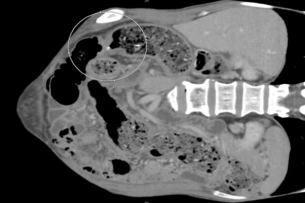 Tưởng rối loạn tiêu hóa, người đàn ông phát hiện bị ung thư đại tràng