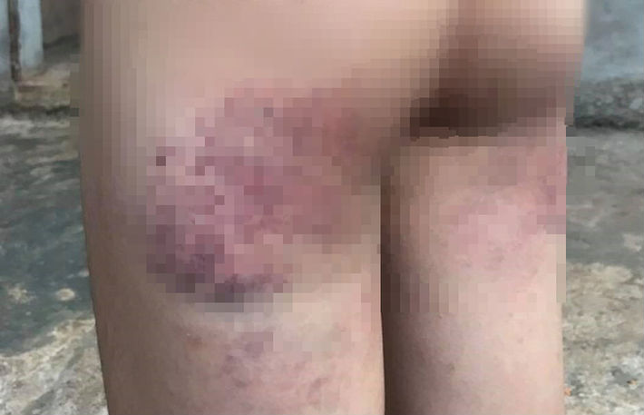 Cô giáo bị tố đánh học sinh lớp 4 bầm tím người do không làm được bài