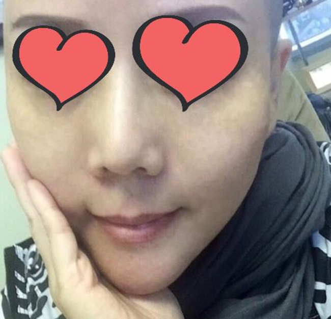 Phẫu thuật căng da mặt khiến cả khuôn mặt người phụ nữ bị bao phủ trong những vết phồng rộp kinh hoàng